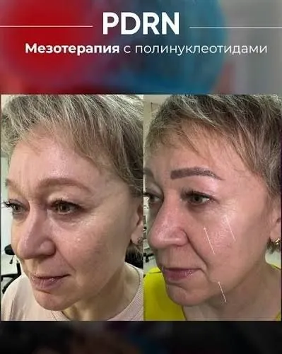 Результат мезотерапії з поліінуклеотидами PDRN — до та після
