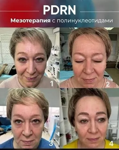 Динаміка результату після курсу мезотерапії з поліінуклеотидами